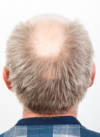 Hair loss. Bald manの写真素材