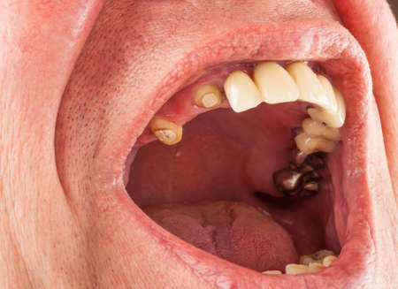 Dentistry. Missing row of teeth in the mouthの写真素材