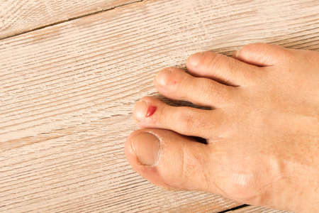 The wound on his leg. A bloody blister on his finger. Close up. On a wooden background