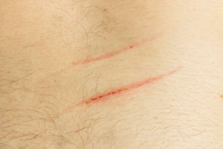 A scratch on the human body. Scar close-up. A deep cut on the body