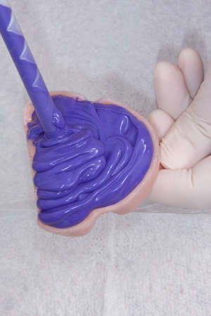 oral rehabilitation process, partial removable prosthesisの写真素材