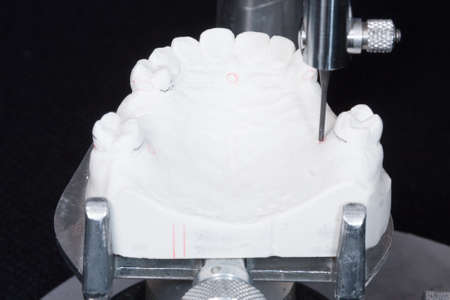 oral rehabilitation process, partial removable prosthesisの写真素材