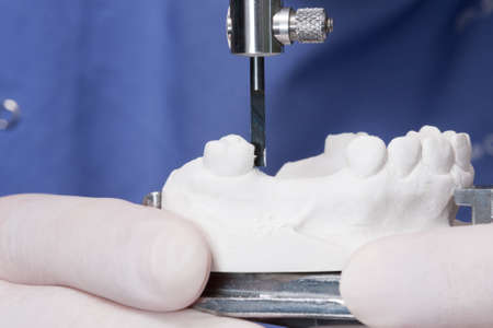 oral rehabilitation process, partial removable prosthesis