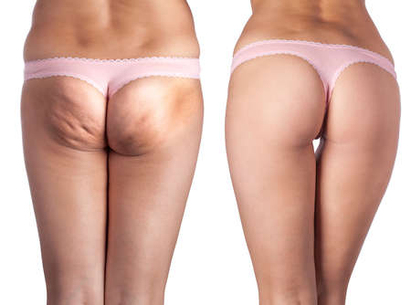 cellulite ass and beautiful ass.