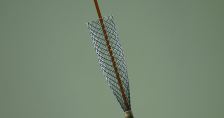 Close-up of a stent deployment prior to insertion. The metal mesh of the stent provides restoration...