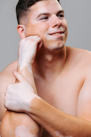 Young man with symmetrical skin pigmentation portrait on a gray studio background smiling one hand props up his chin. The young adult accepts his human body as nature has given it. Studio shot.の写真素材
