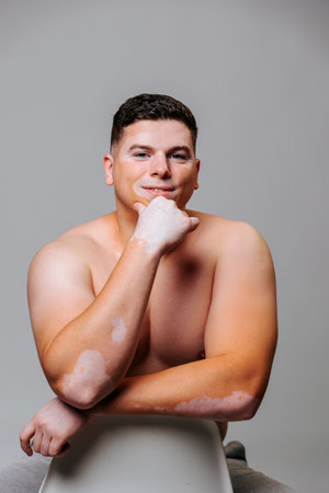 Front view looking at the camera a young man with vitiligo props his chin with one hand, smiles. In the eyes of happiness, not like everyone else, non standard appearance, self love.の写真素材