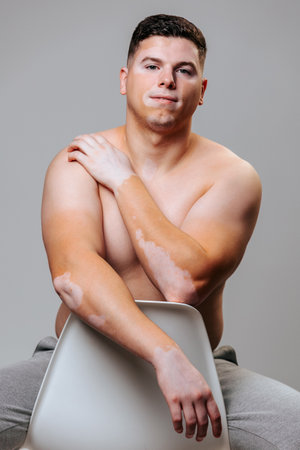 Front view a man with pigmentation sits on a chair rests his hands, looks at the camera. Approximately 60 million people in the world have vitiligo, but many people have no idea what it is.の写真素材