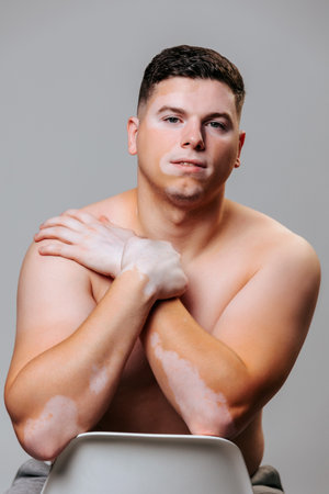 Front view of a young man with vitiligo is photographed in the studio on a gray background in an undressed state. People with the disease lead a normal life, study, work, love themselves.の写真素材