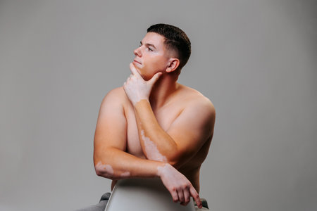 Young man vitiligo in studio shot gray background poses one hand on face on face. Genetic rare disease from a series of dermatological diseases in which you need to accept yourself in a natural body.の写真素材