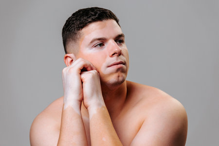 Portrait young man with vitiligo looking thoughtfully into the distance, sitting peacefully on a chair. Person with a dermatological disease accepts himself as he is and calmly looks into the future.の写真素材