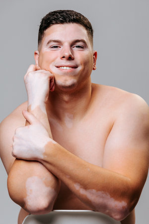 Photo session young man on day of vitiligo pigmentation disorder disease of one percent of people on Earth. Skin depigmentation occurs in ordinary people you must accept your body in its natural form.の写真素材