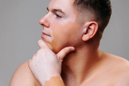 A profile portrait of a non standard young guy with vitiligo, he says that he is handsome. The concept of accepting yourself in any form and image is the key to success. Studio shot, gray background.の写真素材