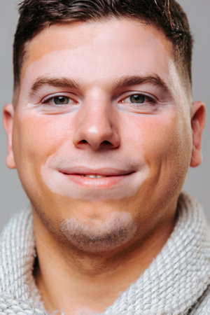 Close up portrait of a young man with symmetrical depigmentation, happy look and content with life. An example for all people with skin diseases. Studio shot front view gray background.の写真素材