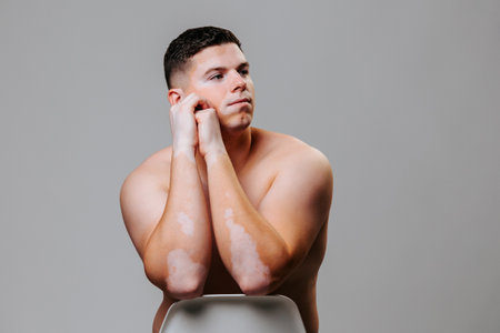 Portrait of a young man with vitiligo showing the imperfection of his skin and accepting himself as such. The concept of tolerance for people with skin diseases. Studio shot gray background front viewの写真素材