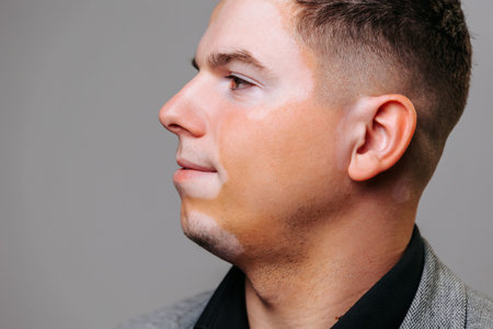 Male with vitiligo showcasing skin condition during dermatology awareness event