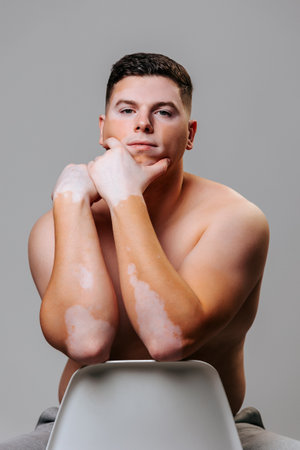 Male model with vitiligo showcases confidence and individuality in studioの写真素材
