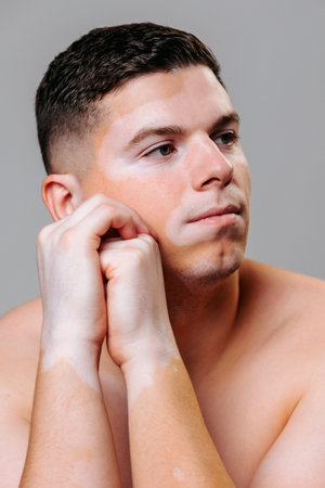 Man with vitiligo poses thoughtfully in a studio setting during a photoshootの写真素材