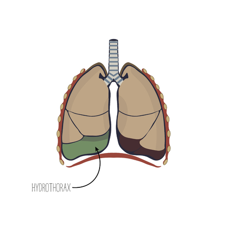 Accumulation of fluid in the pleural cavity of the lungsのイラスト素材