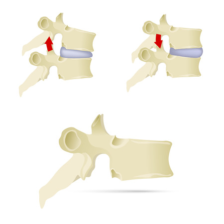 Spine, lumbar vertebra. Facet syndrome, advanced uncovertebral arthrosis, degenerative changes in lumbar vertebra, vertebral bone, lateral view. Flat style, vector illustration.のイラスト素材