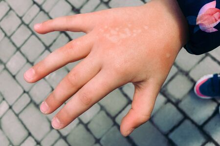 The girl burned her hand with nettle grass. Type of burn.の写真素材