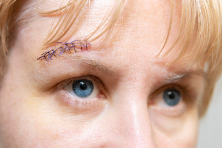 Cut on the womans forehead, sewn up with blue threads. Scar and seam on the head.
