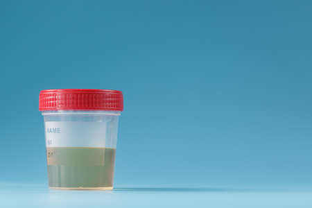 A container for biomaterials with a urine analysis and a red lid on a blue background. The concept of the health check. Free space.の写真素材