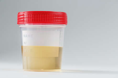 Urine in a jar with a red lid for laboratory analysis on a white background. Detection of abnormalities and diseases. Isolate, free space.の写真素材