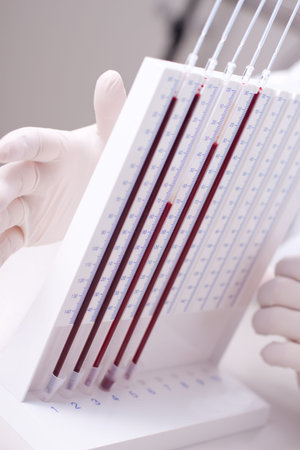 Woman doctor doing erythrocyte sedimentation rate test in laboratory