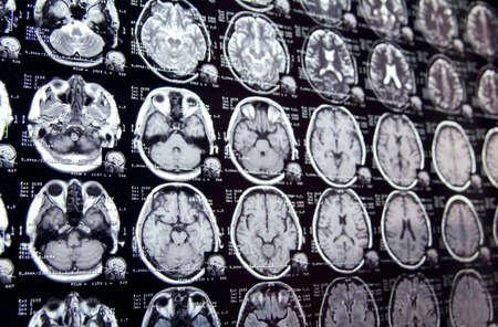 Closeup view of a MRI head scan with brain and skull on it with perspective. Blue toned.の写真素材