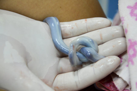 Umbilical cord of new born baby twisted into a knot.
