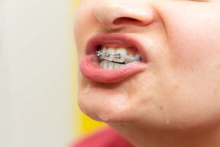 Girl with dental braces and brackets holding toothbrush for dental hygieneの写真素材