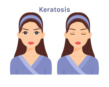 Keratosis. Isolated Beautiful Brunette woman. Cute face. Skin disease.Treatment.Woman with open eyes and closed. White background. Color Flat cartoon illustration.Poster.Vector stock illustration.のイラスト素材