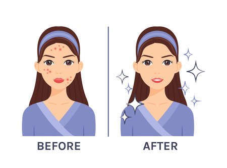 Cute brunette woman with pimples on her face. Acne Treatment. Before after. Problematic and clear skin. Healthy happy lady. Flat cartoon color style. White background. Vector stock illustration.のイラスト素材