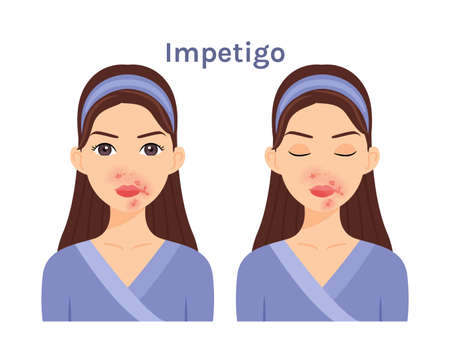 Isolated Cute cartoon Brunette woman with impetigo. Beautiful Face. Skin problems. Girl with open eyes and closed. White background. Color illustration. Vector stock illustration.のイラスト素材