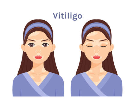 Vitiligo. Portrait of Isolated Beautiful Brunette woman. Cute face. Skin disease.Treatment. Depigmentation skin. Woman with open eyes and closed. White background. Flat cartoon image. Poster. Vectorのイラスト素材