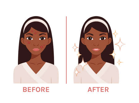 Beautiful Black Woman with Acne. Ugly. Afro Lady with Problem Skin and Clean Face. A Teenage Girl with a Red Rash Before and After. Flat Cartoon Color Style. White background. Vector illustration.のイラスト素材