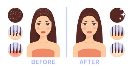 Beautiful Brunette Woman with Dandruff on Hair. Treatment of Scalp. Before and After. Seborrhea Icons. Happy Lady with Clean Hair, with a Smile on Face. Cartoon Style. White background. Vector imageのイラスト素材