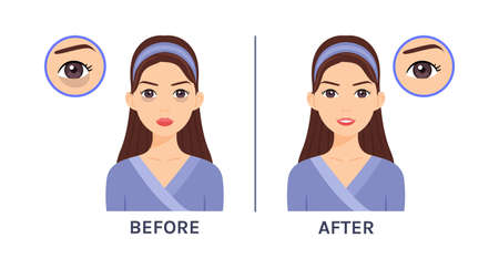 Young, Beautiful Woman with Dark Circles Under her Eyes. Icons. Treatment of Skin Around Eyes. Before and After. Health of Facial skin. Flat Cartoon style. White background. Vector illustration.のイラスト素材