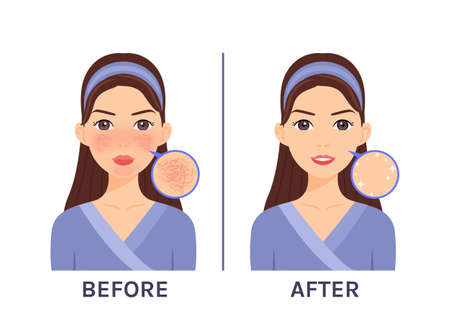 Couperose. Skin Disease, Problem on Beautiful Cartoon Female Face. Treatment of Rosacea. Red Unhealthy skin. Zoom. Before, After. White background. Illustration for Beauty, Medical Design. Vectorのイラスト素材