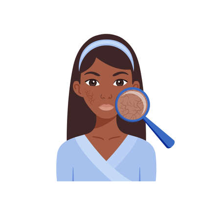 Magnifying Glass and Dry skin. Isolated Beautiful Black Woman with Problem Skin on Face. Dermatology. Treatment, Diagnosis of skin. Flat Cartoon style. Illustration for Beauty, Medical Design. Vector.のイラスト素材