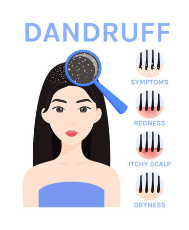 Beautiful Asian Woman with a Magnifying Glass and Dandruff on Head. Treatment of Korean Scalp. Symptoms of dandruff. Icons in a Flat Cartoon style. Illustration for Medicine and Beauty Design. Vector.のイラスト素材