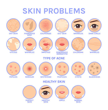 Skin Problems. Set of Icons for Different Skin Diseases of Face. Before After. Healthy Perfect Clean skin. Illustration for Medical and Cosmetic Design. White background. Flat Cartoon style. Vector.のイラスト素材