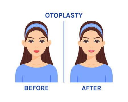 Ear Otoplasty Surgery on a Beautiful Female Face. Before and After. Plastic surgery. Operation. Pretty Ears and a Happy Young Woman. Flat Cartoon Color style. White background. Vector illustration.のイラスト素材