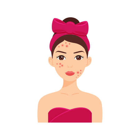 Beautiful Young Woman with Acne and Pimples on Face. skin problem. Pretty Brunette Girl in a Towel and with a Bow on Head. Color cartoon style. white background. Vector illustration for Beauty Design.のイラスト素材