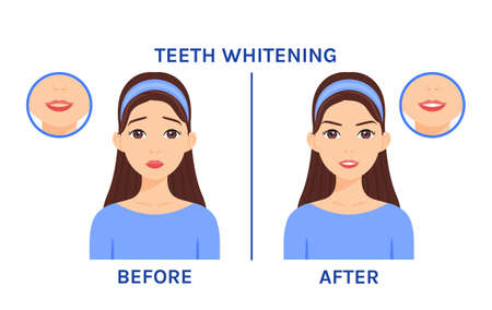 Teeth Whitening. Woman with Yellow Teeth at Dentist. Dental treatment. before after. Healthy White Teeth and a Happy Face with Smile. cartoon style. Vector illustration for Medical and Dental design.のイラスト素材