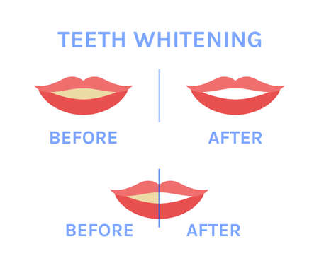 Teeth whitening. Yellow and White Teeth. before and after. Happy Perfect Smile of a Woman. hygiene. Female Lip Icon. cartoon style. white background. Vector illustration for Medical and Dental designのイラスト素材