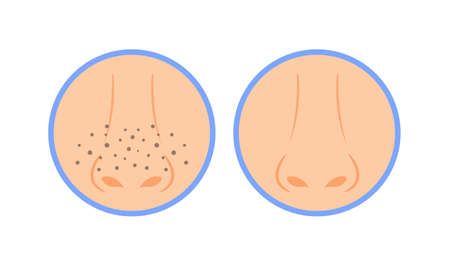 Black Dots on the Nose. Female Nose with Black Spots. before and after. zoom. Healthy Skin and Clean nose. Color cartoon style. white background. Vector illustration for beauty design.のイラスト素材