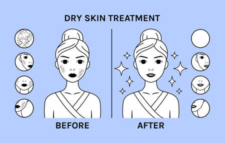 Treatment of Dry Skin. Woman with Dry skin on Face. before after. Clean Healthy skin. Icons and Closeup of Skin problems. zoom. Flat Cartoon Fashion Line Style. Black White Color. vector illustration.のイラスト素材