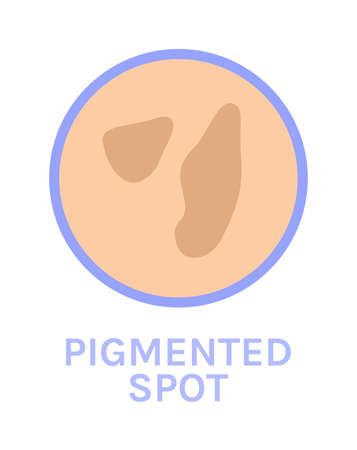 Pigmented Spots on the Skin. skin problem. Pigmentation. Closeup Brown Spots. icon. Color cartoon style. white background. Vector illustration for Beauty and Medical Design.のイラスト素材